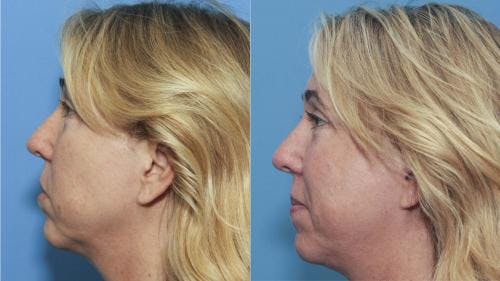 Instalift Before & After Gallery - Patient 58214326 - Image 5