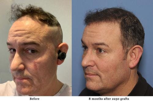 NeoGraft Hair Restoration Before & After Gallery - Patient 58214327 - Image 1