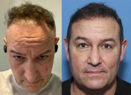 NeoGraft Hair Restoration Before & After Gallery - Patient 58214327 - Image 2