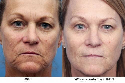Instalift Before & After Gallery - Patient 58214329 - Image 1