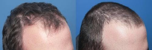 PRP Hair Treatments Before & After Gallery - Patient 58214328 - Image 1