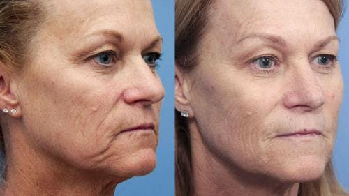 Instalift Before & After Gallery - Patient 58214329 - Image 2