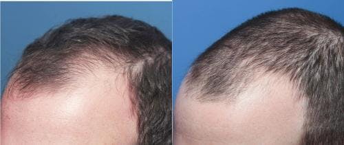PRP Hair Treatments Before & After Gallery - Patient 58214328 - Image 2