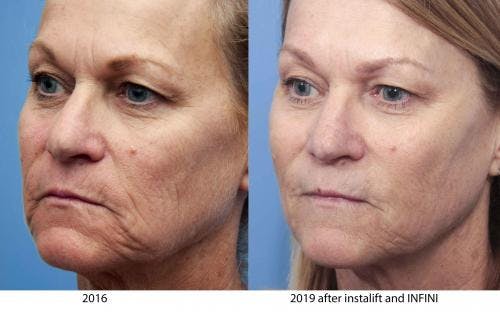Instalift Before & After Gallery - Patient 58214329 - Image 3