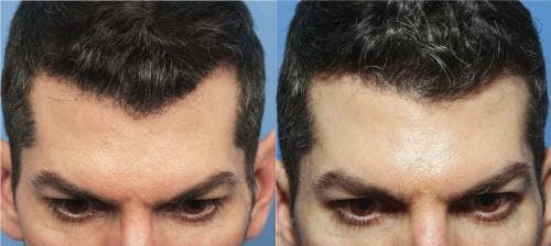 NeoGraft Hair Restoration Before & After Gallery - Patient 58214330 - Image 1