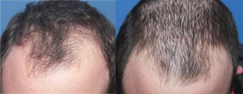 PRP Hair Treatments Before & After Gallery - Patient 58214328 - Image 3