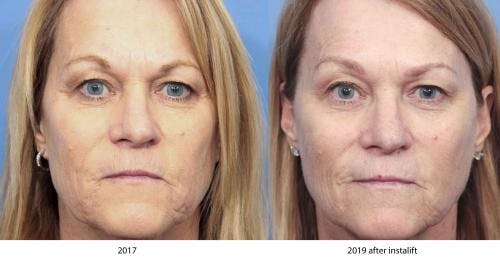 Instalift Before & After Gallery - Patient 58214329 - Image 4