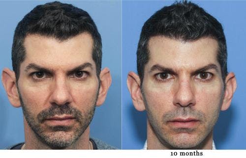 NeoGraft Hair Restoration Before & After Gallery - Patient 58214330 - Image 2