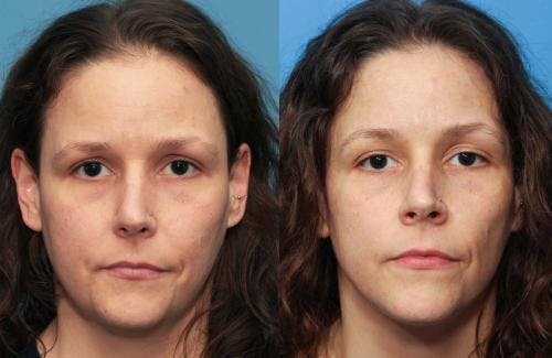 PRP Hair Treatments Before & After Gallery - Patient 58214331 - Image 1