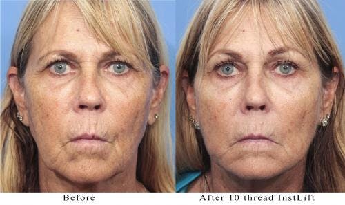 Instalift Before & After Gallery - Patient 58214334 - Image 1