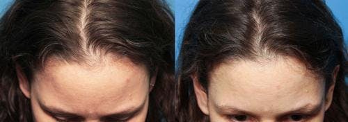 PRP Hair Treatments Before & After Gallery - Patient 58214331 - Image 2