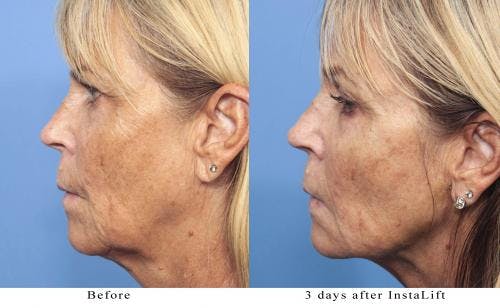 Instalift Before & After Gallery - Patient 58214334 - Image 2