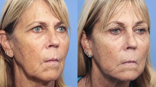 Instalift Before & After Gallery - Patient 58214334 - Image 3