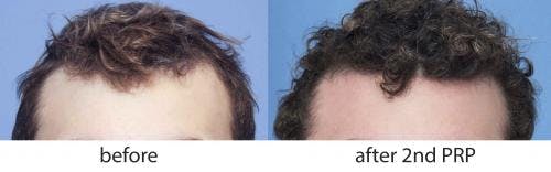 PRP Hair Treatments Before & After Gallery - Patient 58214336 - Image 1