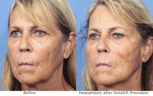 Instalift Before & After Gallery - Patient 58214334 - Image 4