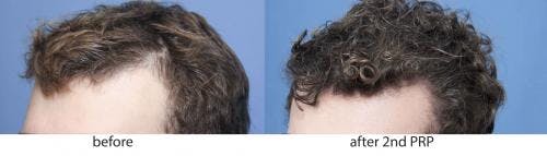 PRP Hair Treatments Before & After Gallery - Patient 58214336 - Image 2