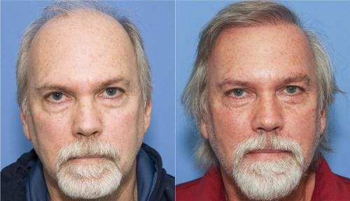 NeoGraft Hair Restoration Before & After Gallery - Patient 58214337 - Image 1