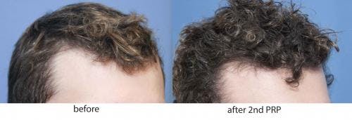 PRP Hair Treatments Before & After Gallery - Patient 58214336 - Image 3