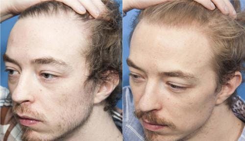 PRP Hair Treatments Before & After Gallery - Patient 58214338 - Image 1