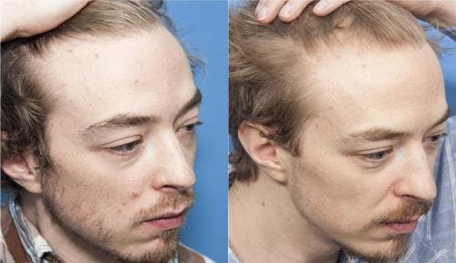 PRP Hair Treatments Before & After Gallery - Patient 58214338 - Image 2