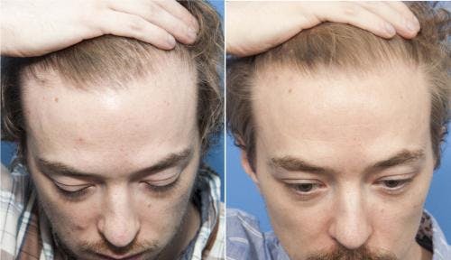 PRP Hair Treatments Before & After Gallery - Patient 58214338 - Image 3
