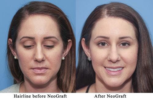 NeoGraft Hair Restoration Before & After Gallery - Patient 58214339 - Image 1