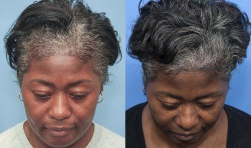 PRP Hair Treatments Before & After Gallery - Patient 58214340 - Image 1