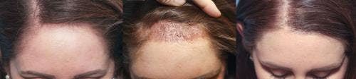 Female Hair Restoration Before & After Gallery - Patient 131385332 - Image 3