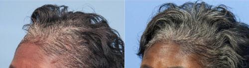 PRP Hair Treatments Before & After Gallery - Patient 58214340 - Image 2