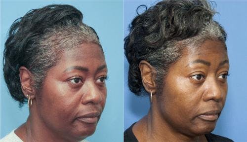 PRP Hair Treatments Before & After Gallery - Patient 58214340 - Image 4