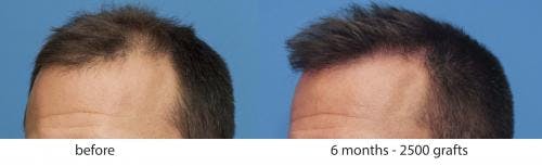 NeoGraft Hair Restoration Before & After Gallery - Patient 58214343 - Image 1