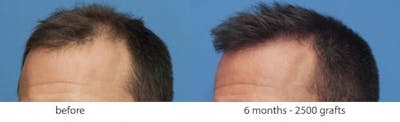 NeoGraft Hair Restoration Before & After Gallery - Patient 58214343 - Image 1
