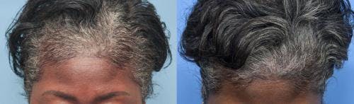 PRP Hair Treatments Before & After Gallery - Patient 58214340 - Image 5