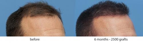 NeoGraft Hair Restoration Before & After Gallery - Patient 58214343 - Image 2
