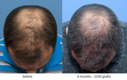 NeoGraft Hair Restoration Before & After Gallery - Patient 58214343 - Image 3