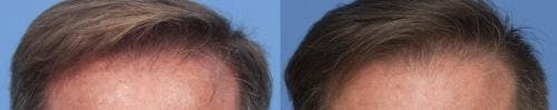PRP Hair Treatments Before & After Gallery - Patient 58214342 - Image 1