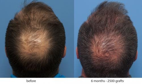 NeoGraft Hair Restoration Before & After Gallery - Patient 58214343 - Image 4