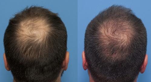 NeoGraft Hair Restoration Before & After Gallery - Patient 58214343 - Image 5