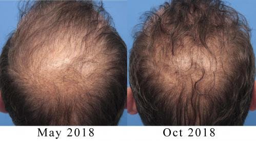 PRP Hair Treatments Before & After Gallery - Patient 58214344 - Image 1