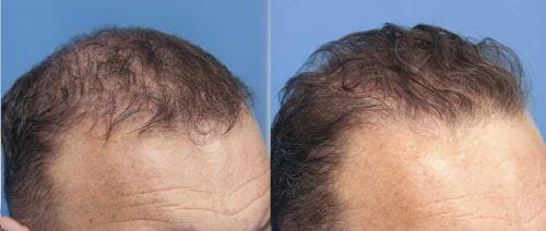 PRP Hair Treatments Before & After Gallery - Patient 58214344 - Image 2