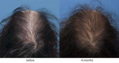 NeoGraft Hair Restoration Before & After Gallery - Patient 58214345 - Image 1