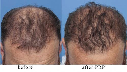 PRP Hair Treatments Before & After Gallery - Patient 58214344 - Image 3