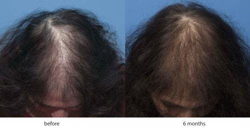 Female Hair Restoration Before & After Gallery - Patient 131385326 - Image 2