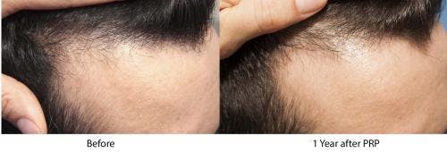 PRP Hair Treatments Before & After Gallery - Patient 58214347 - Image 1