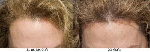 NeoGraft Hair Restoration Before & After Gallery - Patient 58214346 - Image 1