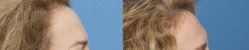 Female Hair Restoration Before & After Gallery - Patient 131385325 - Image 2