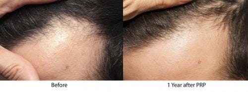 PRP Hair Treatments Before & After Gallery - Patient 58214347 - Image 2