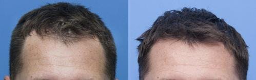 NeoGraft Hair Restoration Before & After Gallery - Patient 58214348 - Image 1