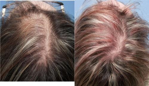 PRP Hair Treatments Before & After Gallery - Patient 58214349 - Image 1