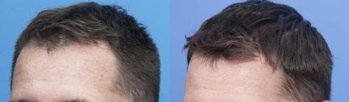 NeoGraft Hair Restoration Before & After Gallery - Patient 58214348 - Image 2